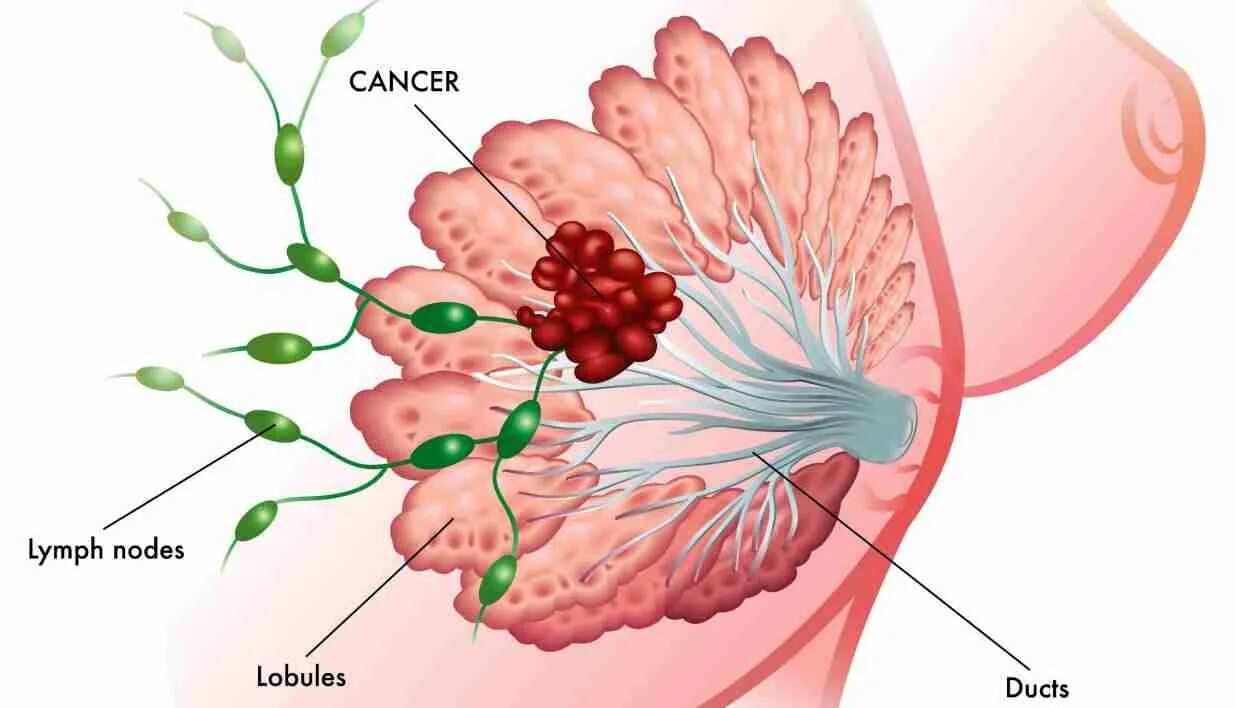 Лимфоузлы в женской груди. Лимфоузлы в грудной железе у женщин. Увеличен лимфоузел в молочной железе