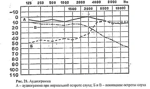 Аудиометрия заключается в определении