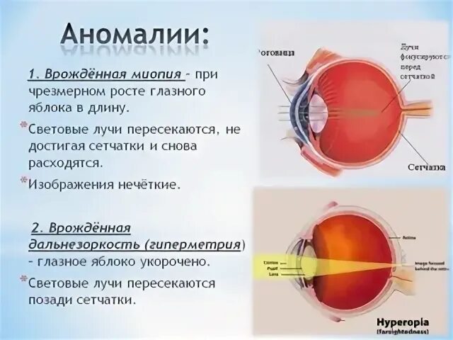 Главная аномалия. Форма глазного яблока при дальнозоркости. Близорукость форма глазного яблока. Глазное яблоко анатомия при миопии. Форма глазного яблока при близорукости.