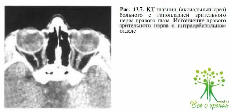 Гипоплазия 12 пары ребер. Гипоплазия зрительного нерва. гипоплазия зрительного нерва мрт. гипоплазия зрительных нервов.