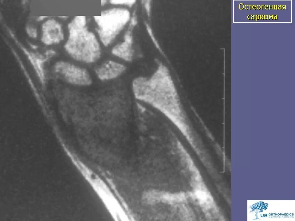 Саркома юинга у детей. Саркома мягких тканей бедра мрт.