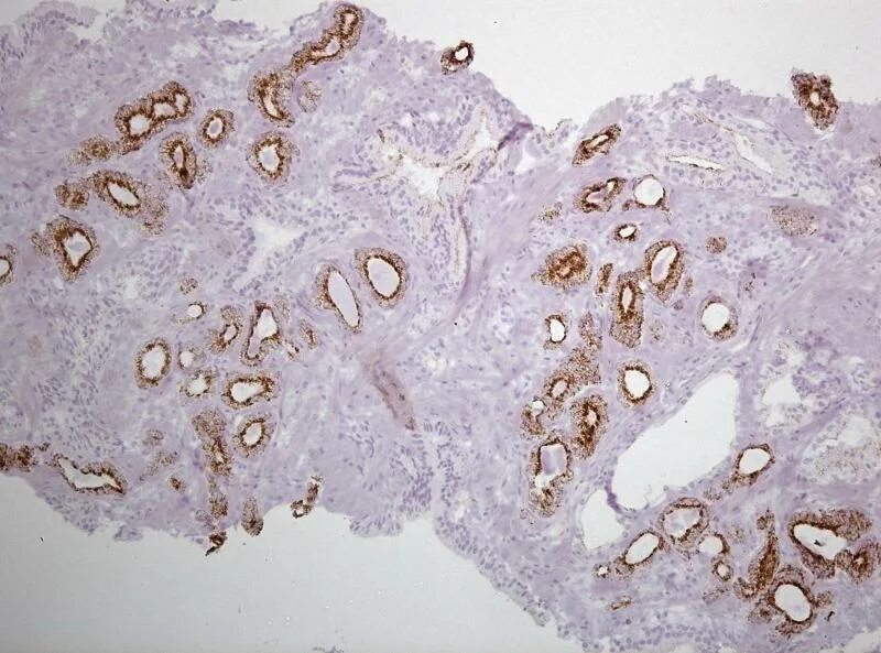 Ацинарная аденокарцинома. Ацинарная аденокарцинома предстательной железы. Атипическая мелкоацинарная пролиферация предстательной железы. Иммуногистохимия предстательной железы. Ацинарная аденокарцинома предстательной железы глисон 7