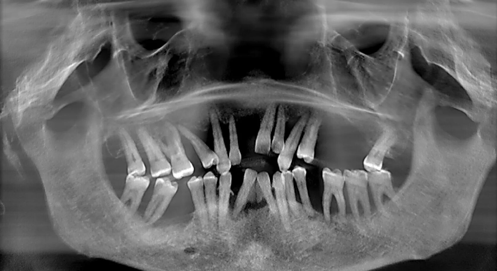 Ортопантомограмма пародонтит. Рентген ортопантомограмма зубов. Пародонтит снимок ОПТГ. Ортопантомограмма пародонтит тяжелой степени.