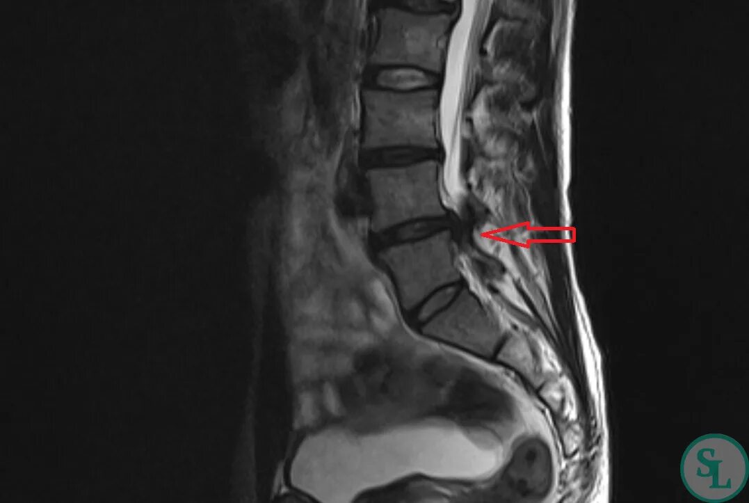 Диск l4-s1. L4 l5 s1 отдел позвоночника. Межпозвонковые диски l4/l5 l5/s1. Грыжа l5-s1.