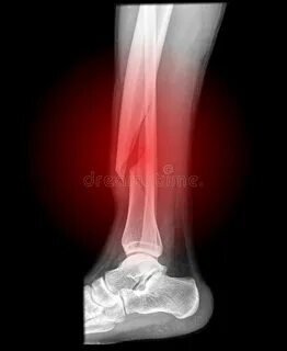 Open fracture