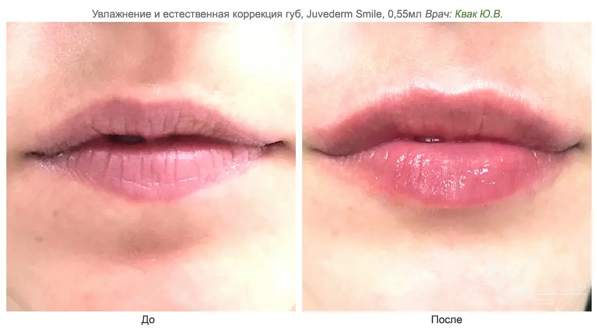 Увлажнение губ без увеличения до и после Увлажнить губы гиалуроновой