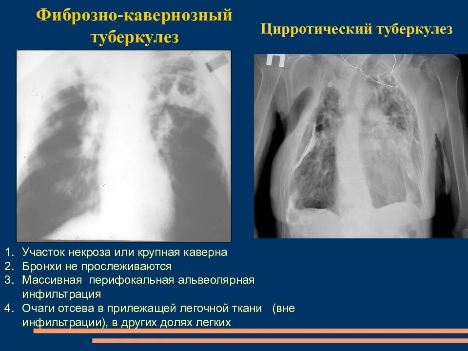 Цирротический туберкулез легких на снимках. Фиброзно-кавернозный туберкулез легких рентген и кт. Цирротический туберкулёз лёгких кт. Диссеминированный кавернозный туберкулез кт.