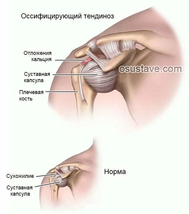 Артроз ключично-акромиального сустава. Хрустит правое плечо. Капсульно-связочный аппарат плечевого сустава. Передний вывих плечевого сустава. Мышцы ротаторной манжеты плеча анатомия.