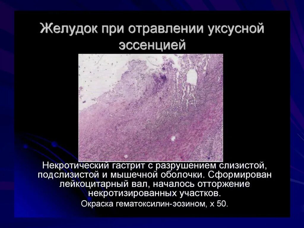 Клинические симптомы при отравлении уксусной кислотой. Отравление уксусной эссенцией. Отравление уксусной эссенцией симптомы. Отравление уксусной эссенцией симптомы. Отравление уксусной эссенцией.