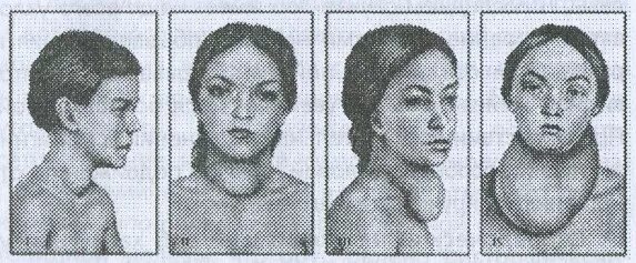Диффузный объем. Диффузный эндемический зоб. диффузный зоб щитовидной железы. зоб 1 степени щитовидной железы что это.