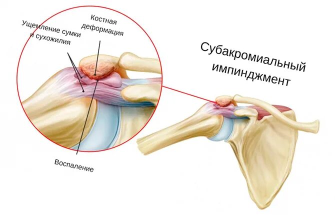 Синдром манжета. Субакромиальный импиджмент плечевого сустава. Синдром манжета. Импиджмент синдром плечевого. Подакромиальный импиджмент синдром.