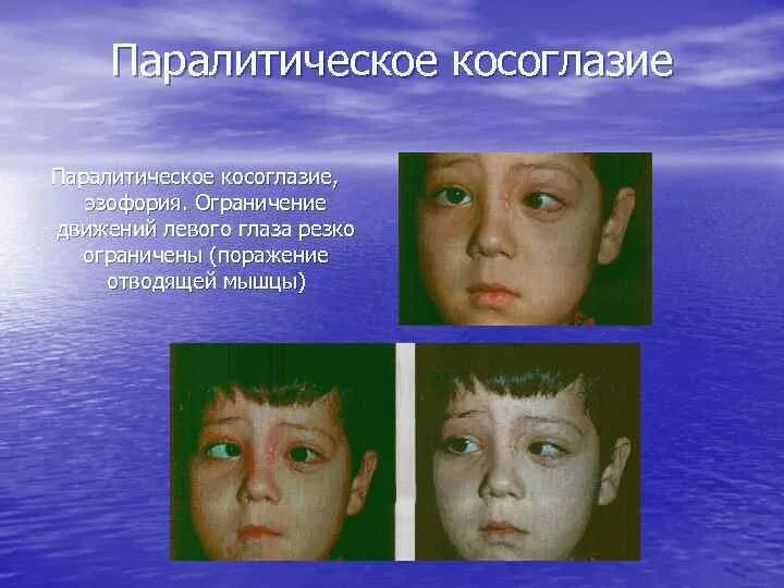 Косоглазие симптомы. Паралитисеское комогоазие. содружественное и паралитическое косоглазие. паралитическое расходящееся косоглазие. крсоглазие назалетичечкое.