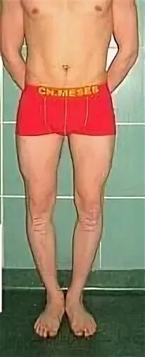 Correction of a big O-deformity of legs. Young patient with genu varum.. Bow leg