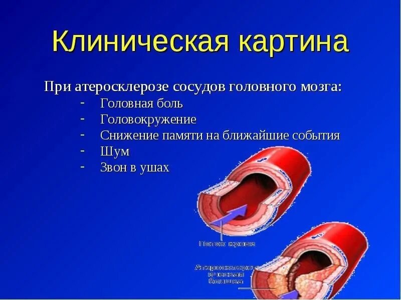 Лечение заболеваний сосудов. Клиническая картина атеросклероза. Атеросклероз сосудов головного мозга.