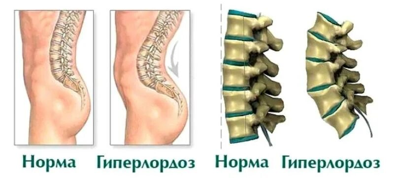 Лордоз поясничного отдела позвоночника: что это такое, лечение сглаженного поясн