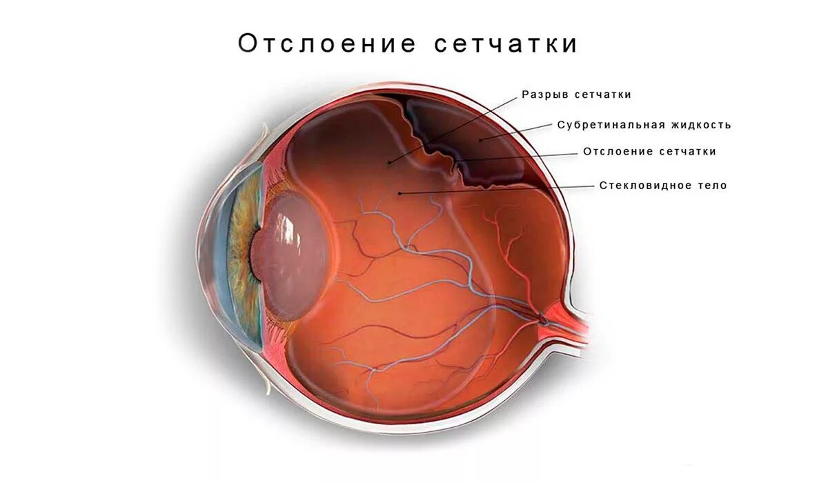 Отслойка сетчатки глаза. Нерегматогенная отслойка сетчатки. Отслойка сетчатки катаракта. Отслоение сетчатки на глазу на глазах.