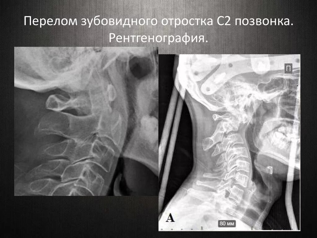 Трещина 2. Перелом зубовидного отростка рентген. Перелом 2 шейного позвонка рентген. Рентген зубовидного отростка с2. Зубовидный отросток с2 позвонка рентген.