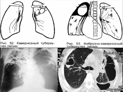 Кавернозный туберкулез кт