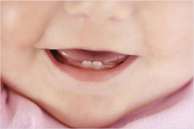 Кр вый. Десна при прорезывании зубов у ребенка. Прорезывание молочных зубов Десна.