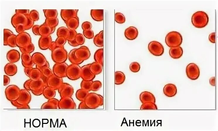 Анемия пятна
