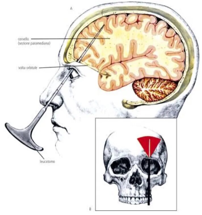 В мозг через глаза. Трансорбитальная Лоботомия.