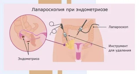 После удаления яичников сколько в больнице