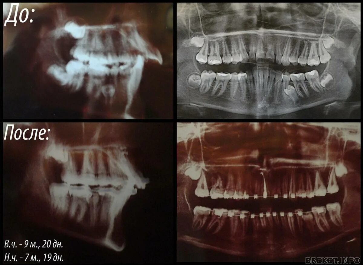 Мрт можно делать с брекетами на зубах. Правильный прикус рентген. Правильный прикус на панорамном снимке.