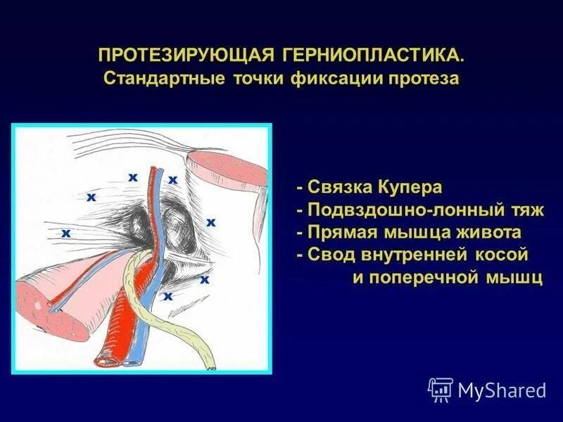 связка купера паховый. связка купера паховый. глубокое кольцо бедренного канала спереди ограничено. паховая связка и паховая грыжа. связка купера паховый.