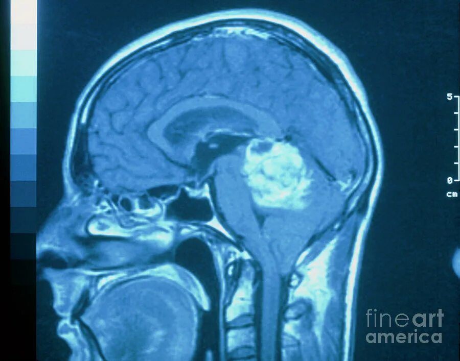 Brain 254. Опухоль головного мозга рентген. Опухоль головного мозга рентген в руках. Доброкачественная опухоль мозга.