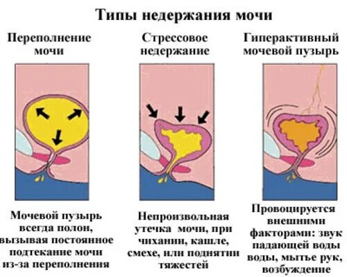 Непроизвольное Мочеиспускание У Женщин Во Время Секса