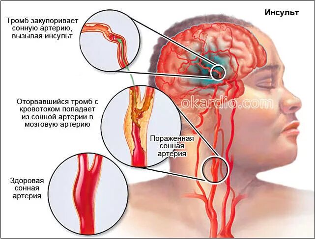 Микро ишемический инсульт. Тромбоз сонной артерии. Тромбоз мозговых сосудов
