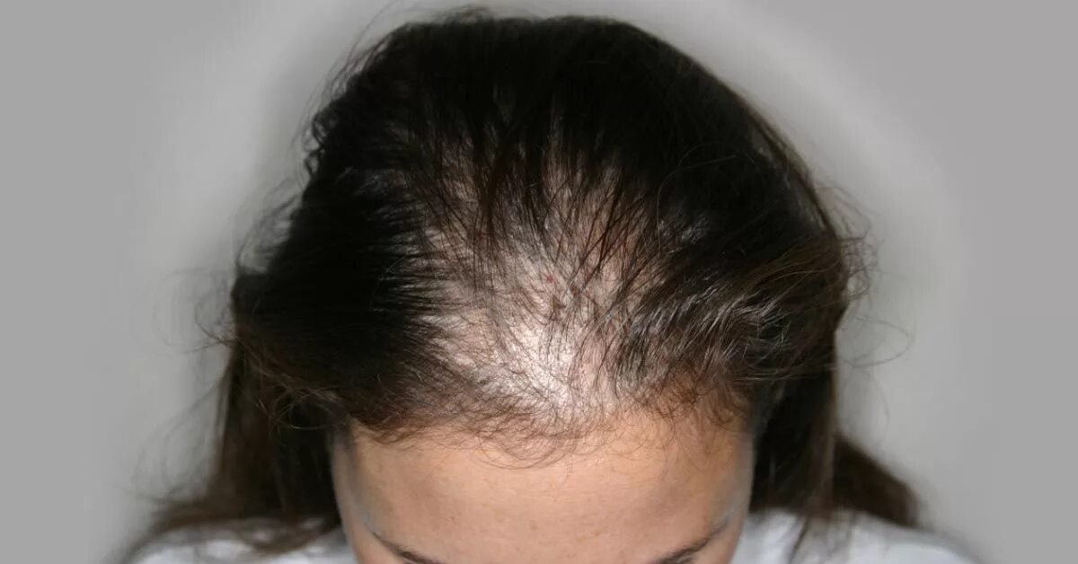 Редкие волосы у женщин. 11 лет выпадают волосы