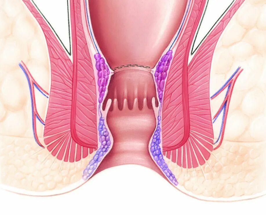 Снять спазм сфинктера при трещине. Хроническая трещина заднего прохода. Геморройный узел наружный. Наружные геморроидальные бахромки.