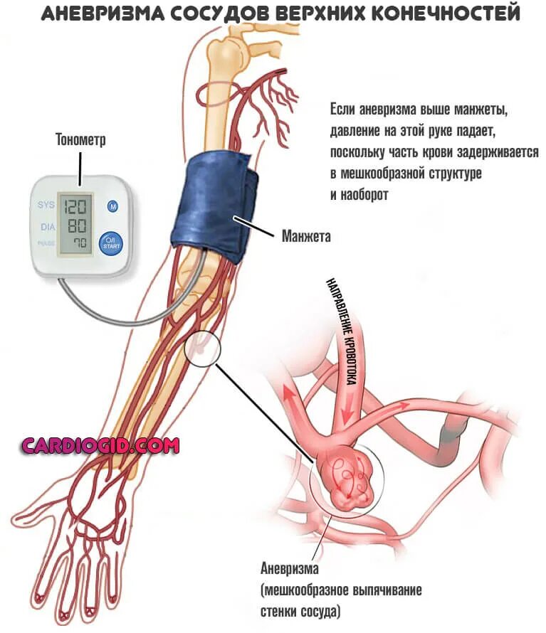 Сужение сосудов повышение давления. Артериальное давление вен. Артерии верхней конечности.