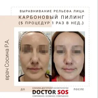 Карбоновый пилинг для лица отзывы