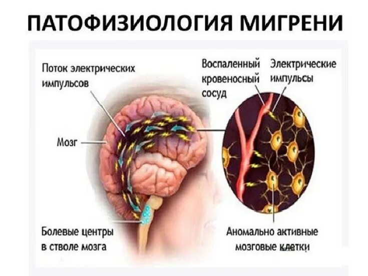 Болевой центр в мозге. Мигрень. Мигрень механизм возникновения. Мигрень заболевание нервной системы. Мигрень патофизиология.