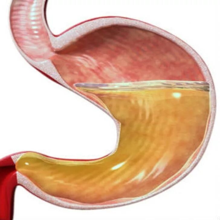 Почему выделяется желудочный сок. Гиперацидный гастрит. Повышенной секреции желудка. Желудочная гиперсекреция.