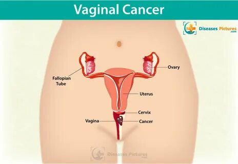 Vaginal Cancer - Types, Symptoms, Causes, Stages, Treatment, Prevention HealthMD