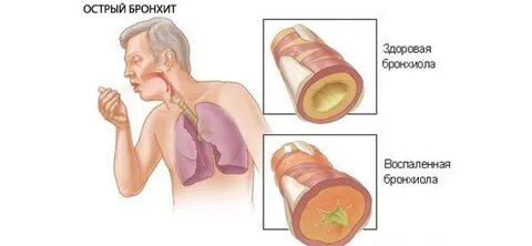 Что такое бронхит простыми словами