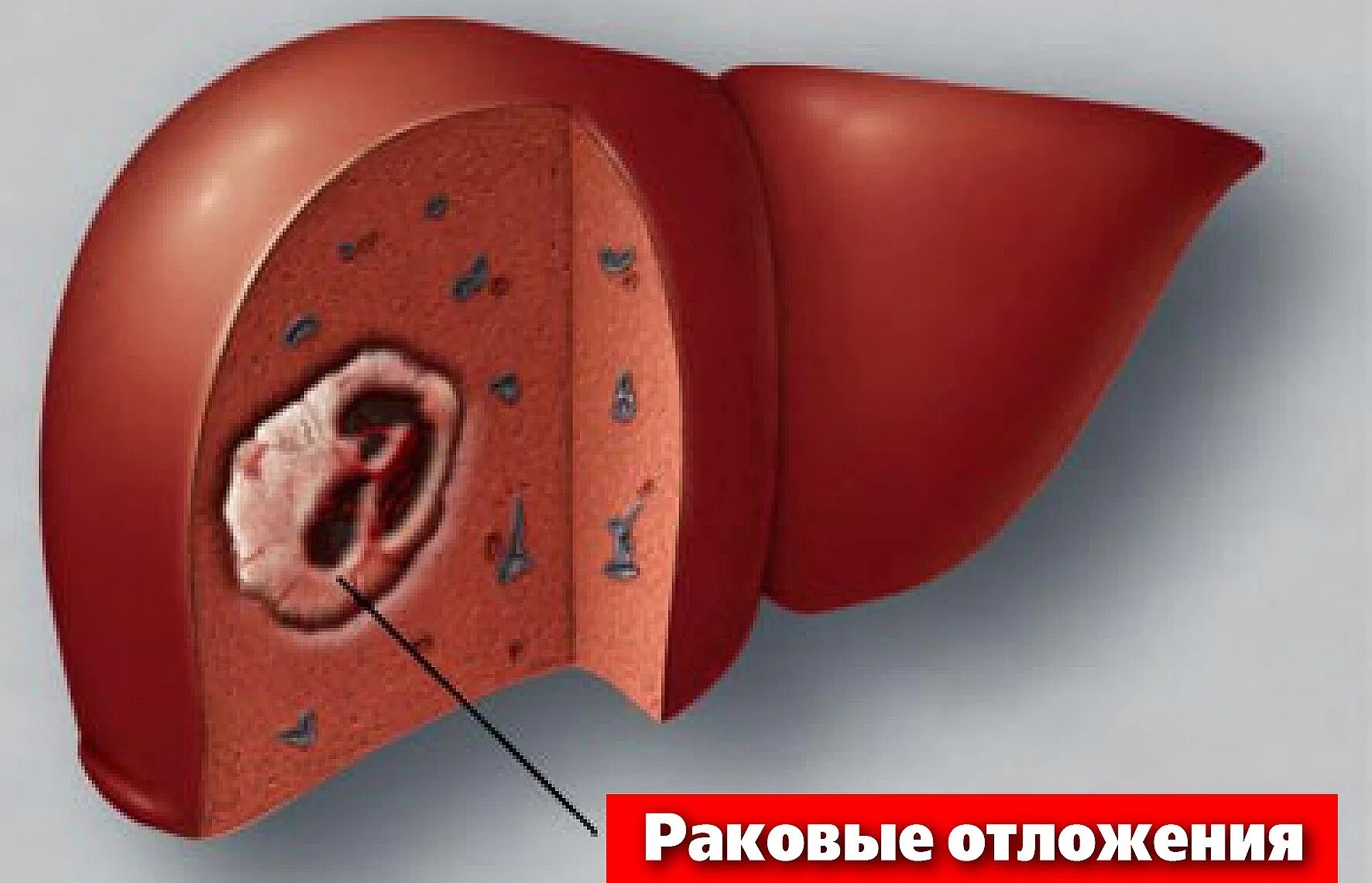 Гепатоцеллюлярная карцинома печени. Раковая опухоль печени. Злокачественные опухоли печени. Удаление опухолей печени