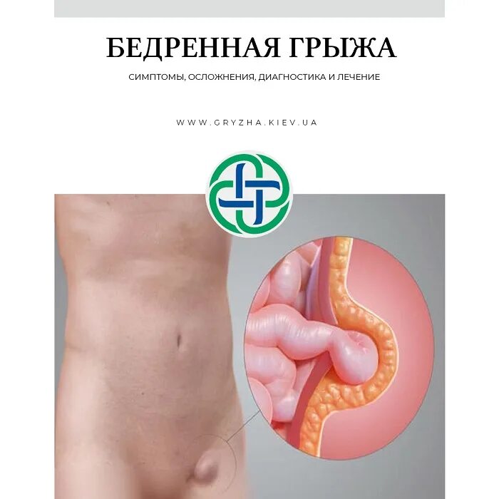 Грыжа слева симптомы