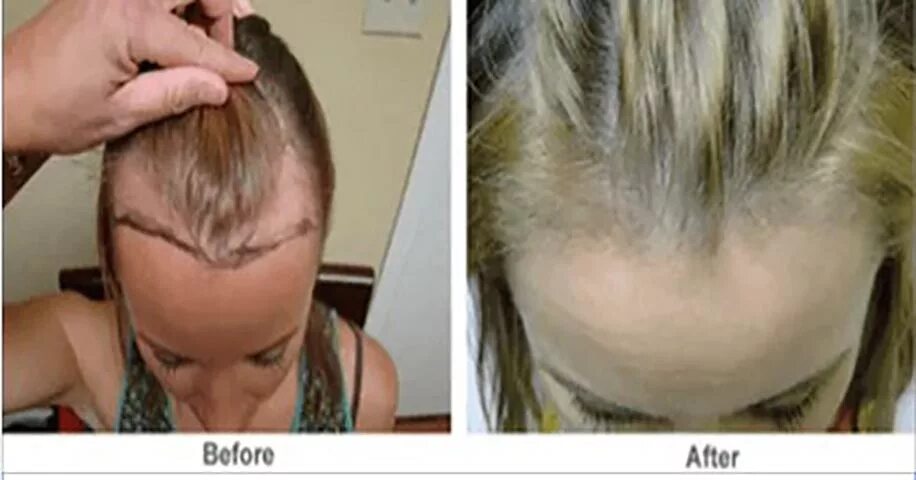 Болячки на голове после осветления. Наращивание волос при алопеции. Аллергия на краску длятволос. Ожоги волос. Окрашивание синтетических волос.