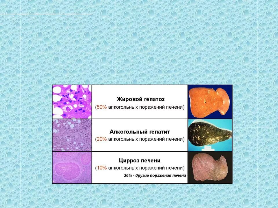 Жировой перестройки. Жировая дегенерация печени гепатоз. Формы алкогольной болезни печени. Жировой гепатоз 3 степени. Стадии поражения печени алкоголем.