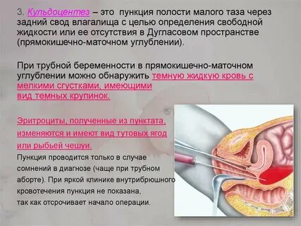 Как часто можно делать пункцию
