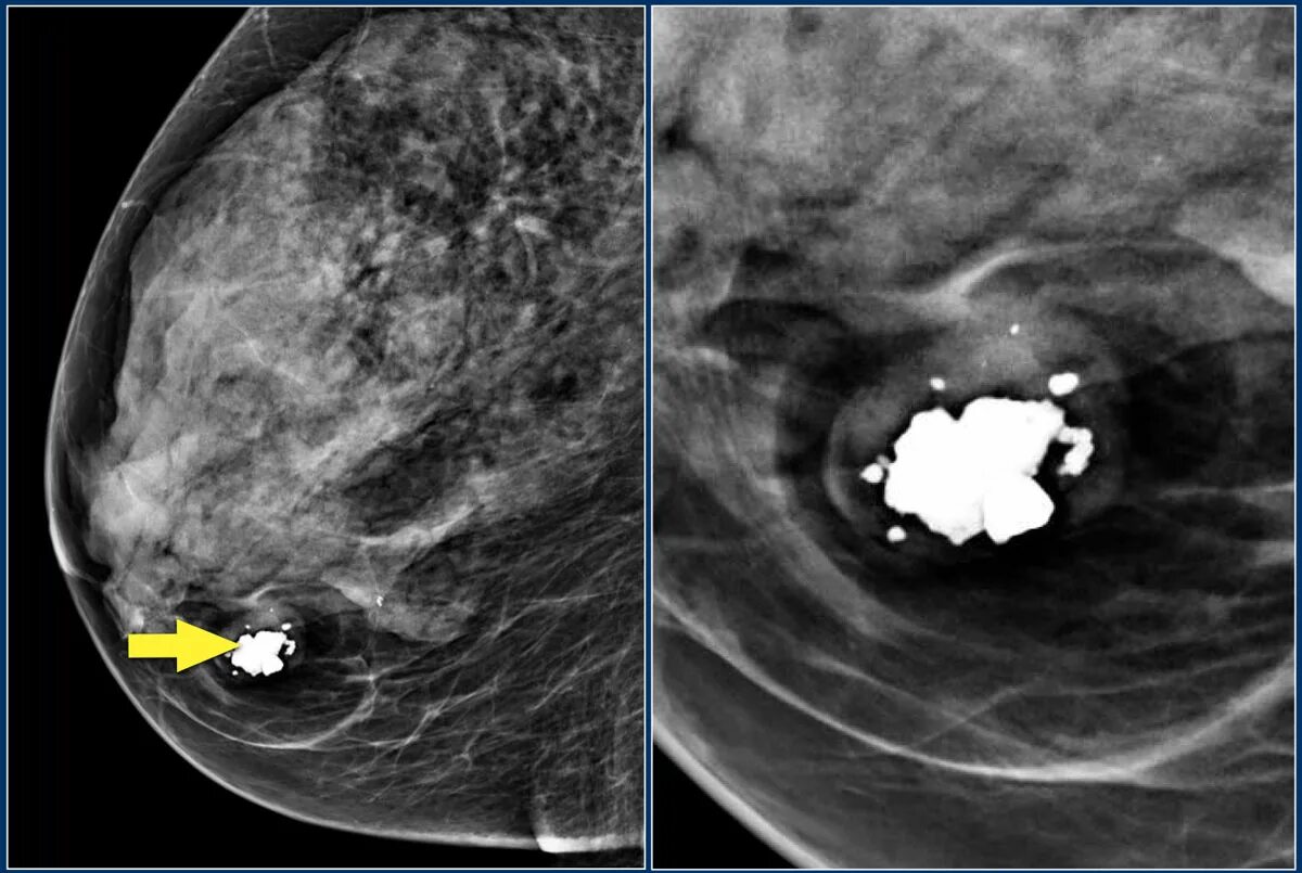 Асимметрия плотности молочных желез. Что такое bi rads 3 на маммографии. Маммография bi-rads 2. Асимметрия плотности молочных желез. Маммография birads очаговая асимметрия.