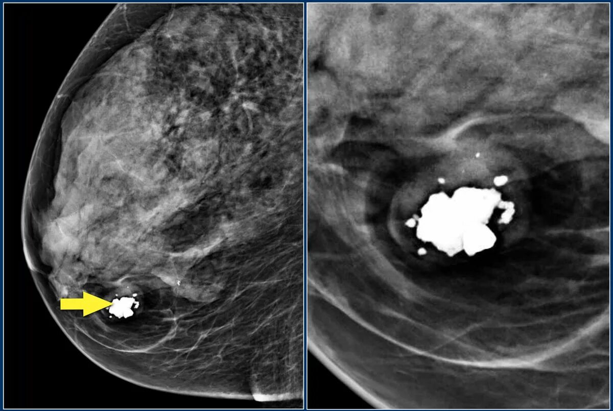 Фиброаденоматоз bi. Фиброаденома молочной железы кт. Фиброаденома молочной железы маммография. Гамартома маммография. Фиброзно-кистозная мастопатия маммография bi-rads.
