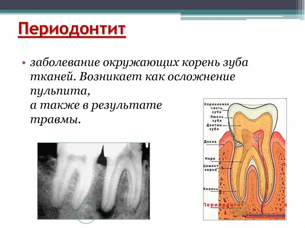 Зуб дает температуру. Симптомы пульпит и периодонтит. Хронический периодонтит пульпит. Апикальный периодонтит рентген.