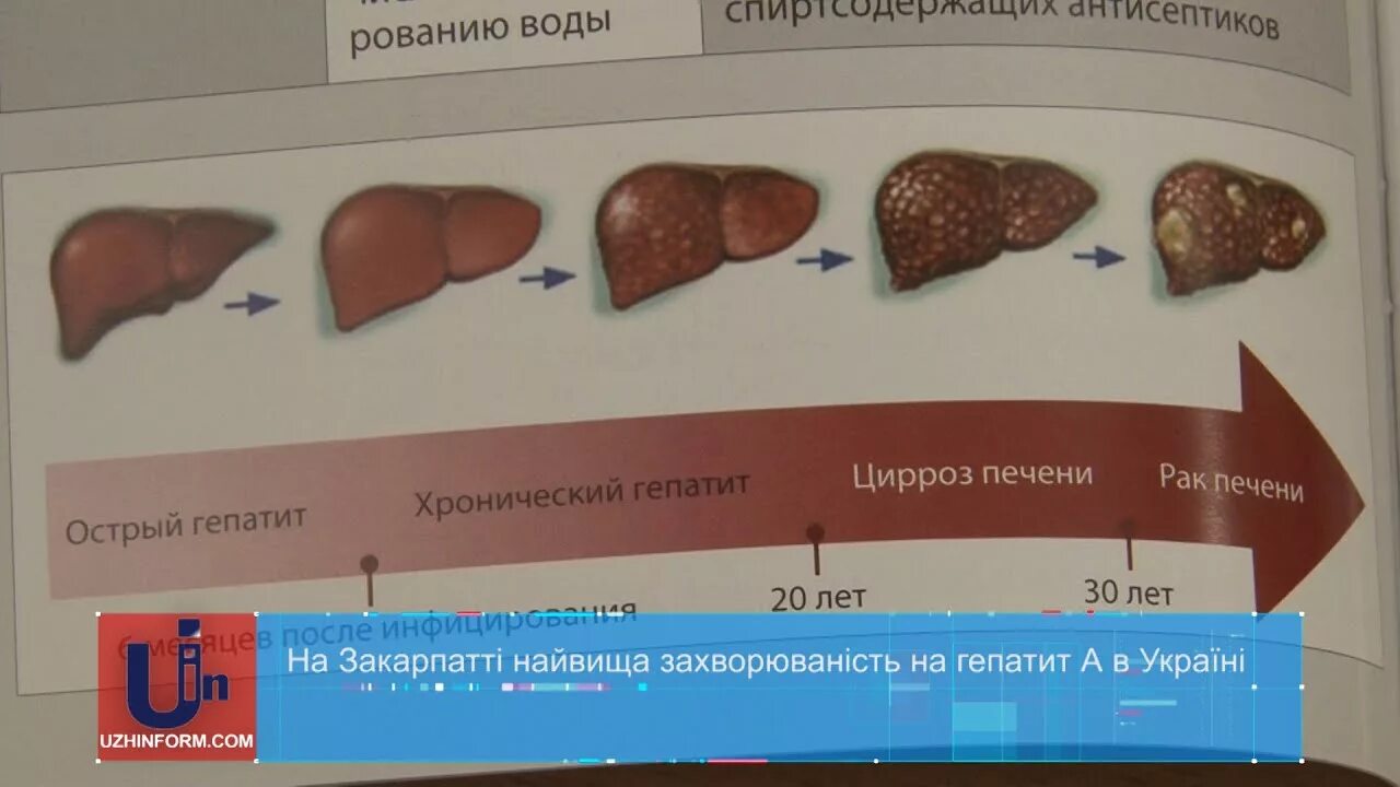 Быстрее разлагается печень песня. Поражение печени у животных.