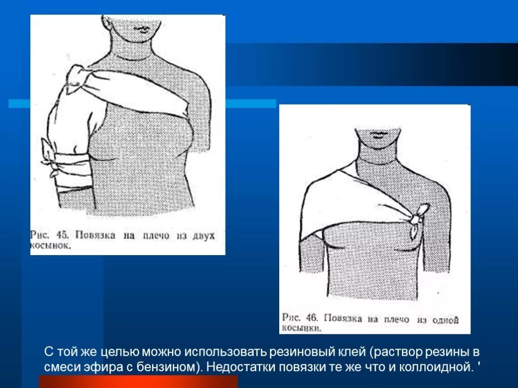 Плечевая повязка алгоритм. Повязка на плечевой сустав десмургия. Спиральная повязка на плечо. Колосовидная повязка на плечевой. Клеевая повязка десмургия.