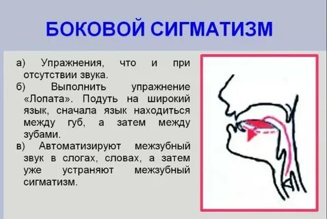 Что такое сигматизм